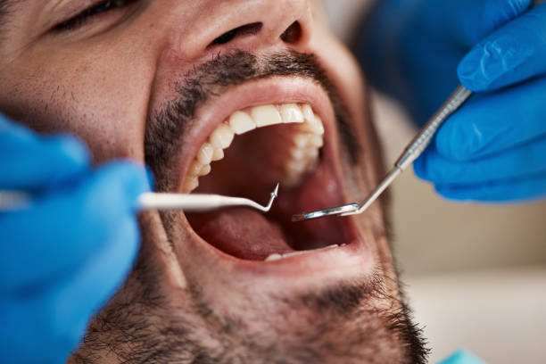 Best Emergency Treatment for Dental Infections or Abscesses in Lake Don Pedro, CA